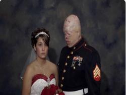 美國士兵在前線臉被炸爛，女友雖為愛嫁給他但整場婚禮卻「沒笑過」…